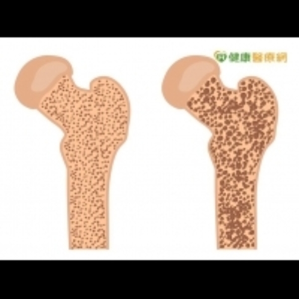 驚！　10年內4人有1人將成為骨鬆族