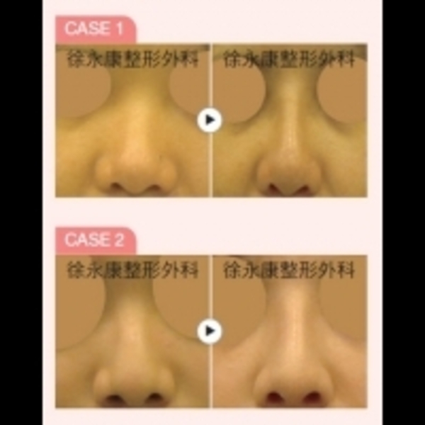 明星級美鼻締造術 日式隆鼻 - ENews新聞網