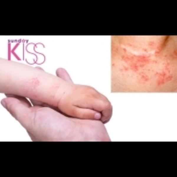 紓緩小兒 濕疹 飲食生活習慣做起