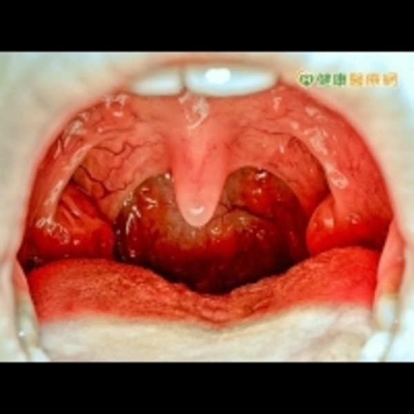 自我檢測口腔　3大症狀恐是癌症前兆