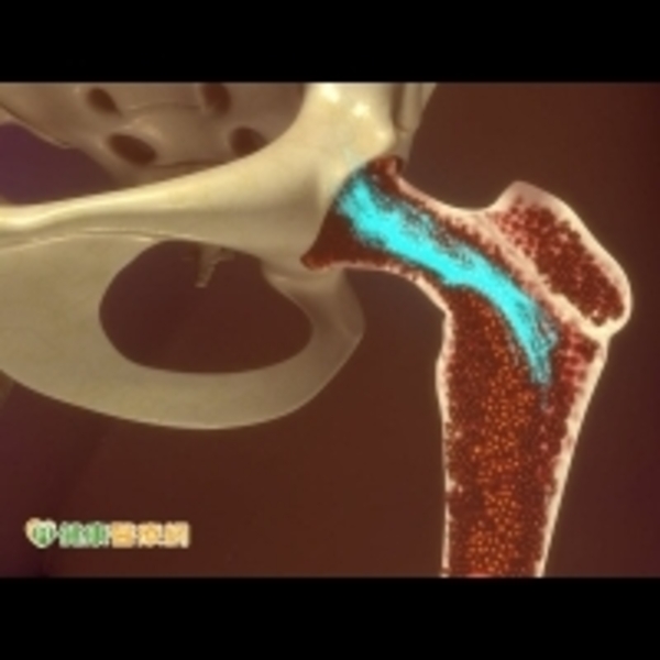 為何日漸消瘦？　小心骨髓纖維化上身
