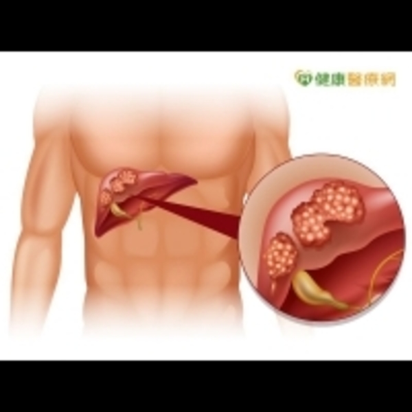 肝癌小於5公分　射頻燒灼術療效佳