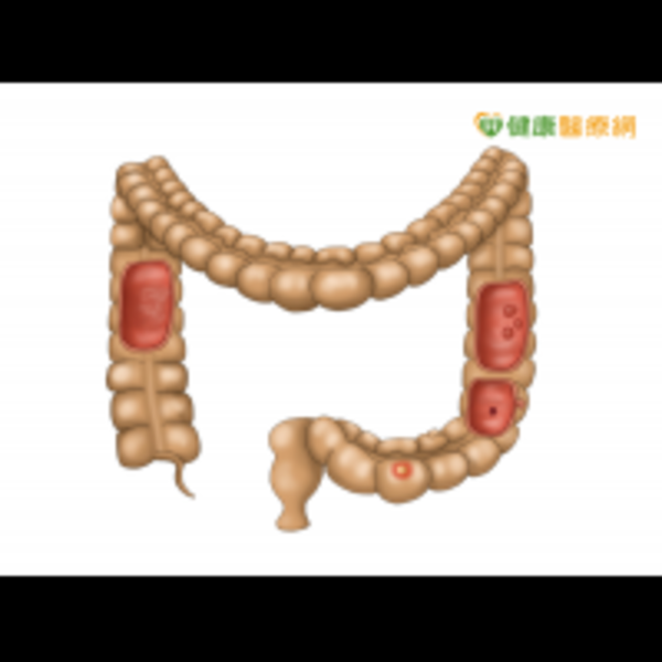 銀髮族好發大腸癌　是否會較為惡性？