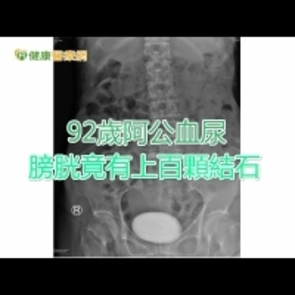 92歲阿公血尿　膀胱竟有上百顆結石