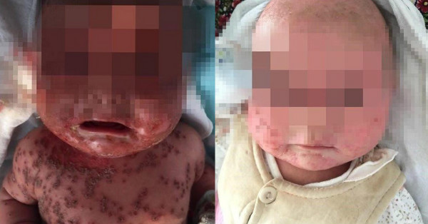 嚇！媽媽一個吻　竟讓女嬰全身長滿皰疹