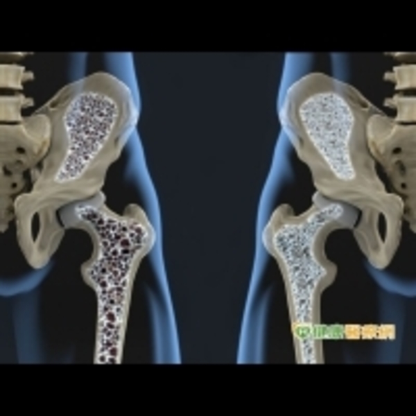 X光驚見骨頭坑坑洞洞　攝護腺癌骨轉移這樣治療可保骨