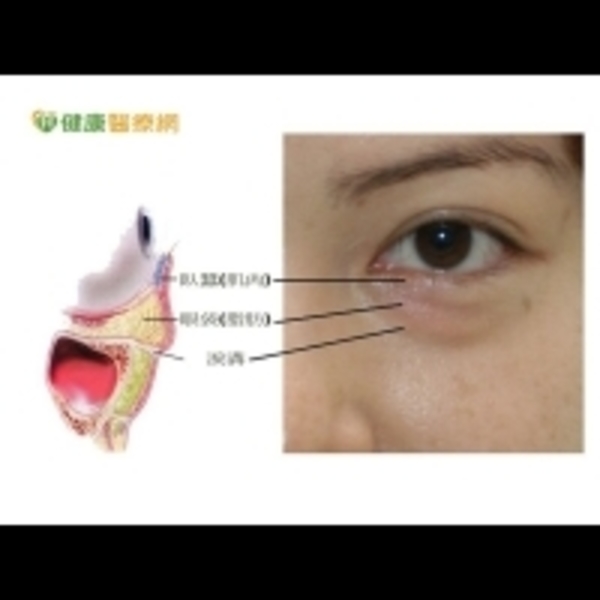 眼袋年齡層降低 　過度使用3C產品成誘因