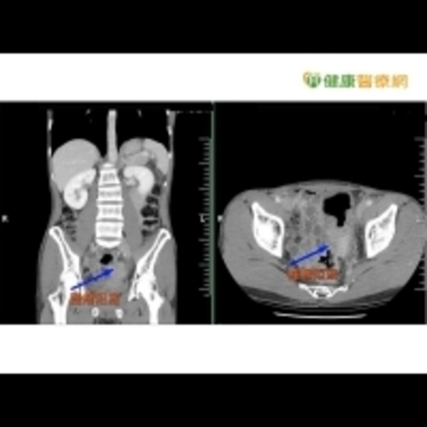大腸癌年輕化　腹脹血便是徵兆
