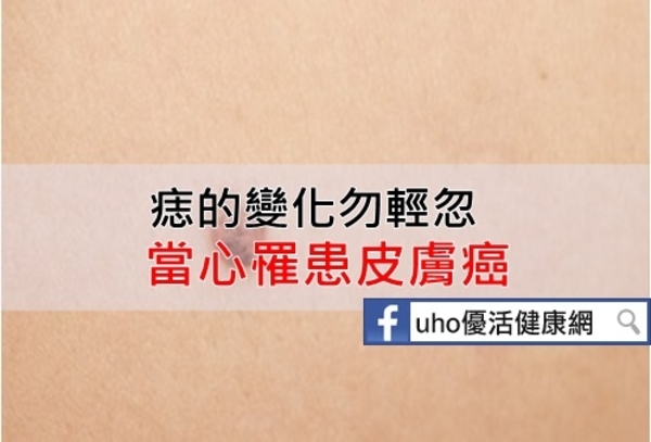 痣的變化勿輕忽　當心罹患皮膚癌