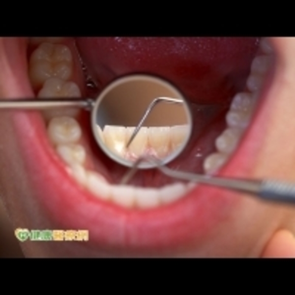 還在用醋洗牙結石？　正確潔牙卡實在