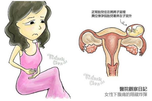 女性下腹痛的隱藏炸彈　比經痛可怕的異位懷孕