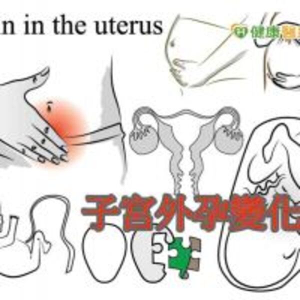 非經期出血或懷孕找不到肧胎　小心子宮外孕