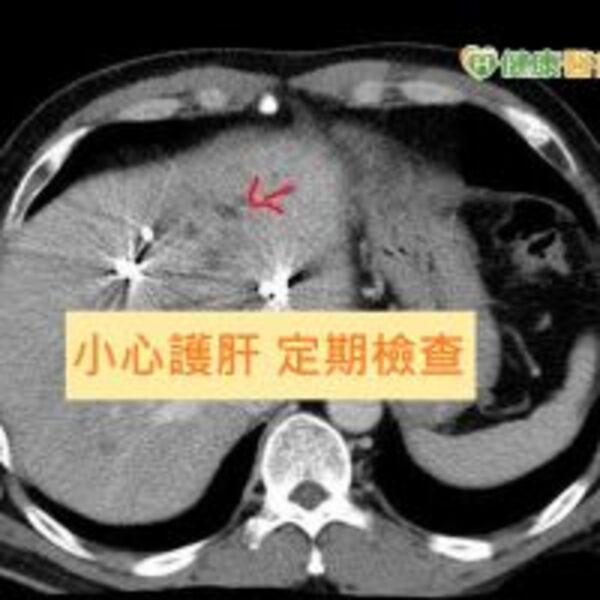 以為只是「腹痛 」　竟是肝癌惹禍