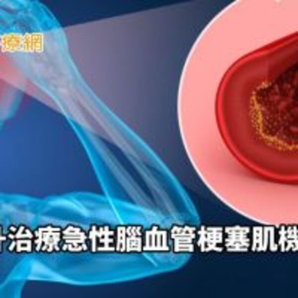 治療急性腦血管梗塞　研究：使用機械取栓器提升預後