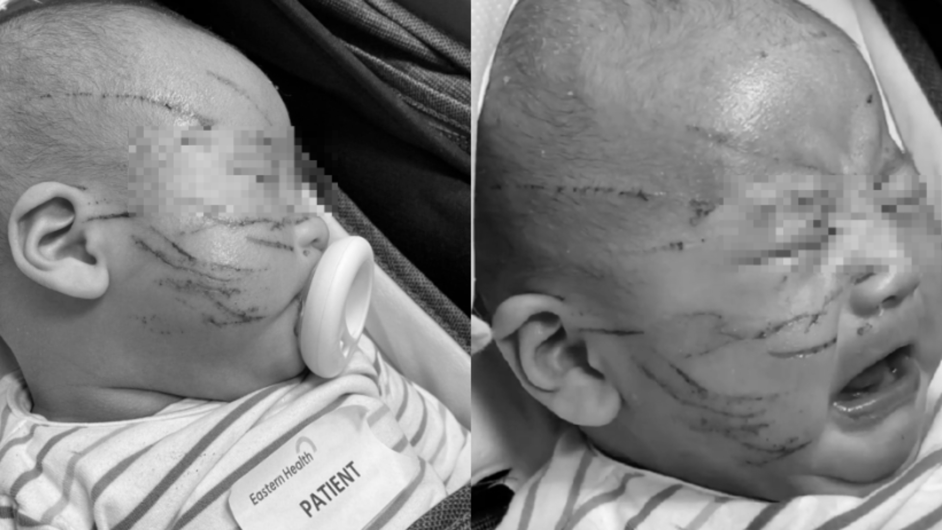 澳洲10週大寶寶「臉上20幾道血痕」！托嬰中心辯稱意外　母心碎