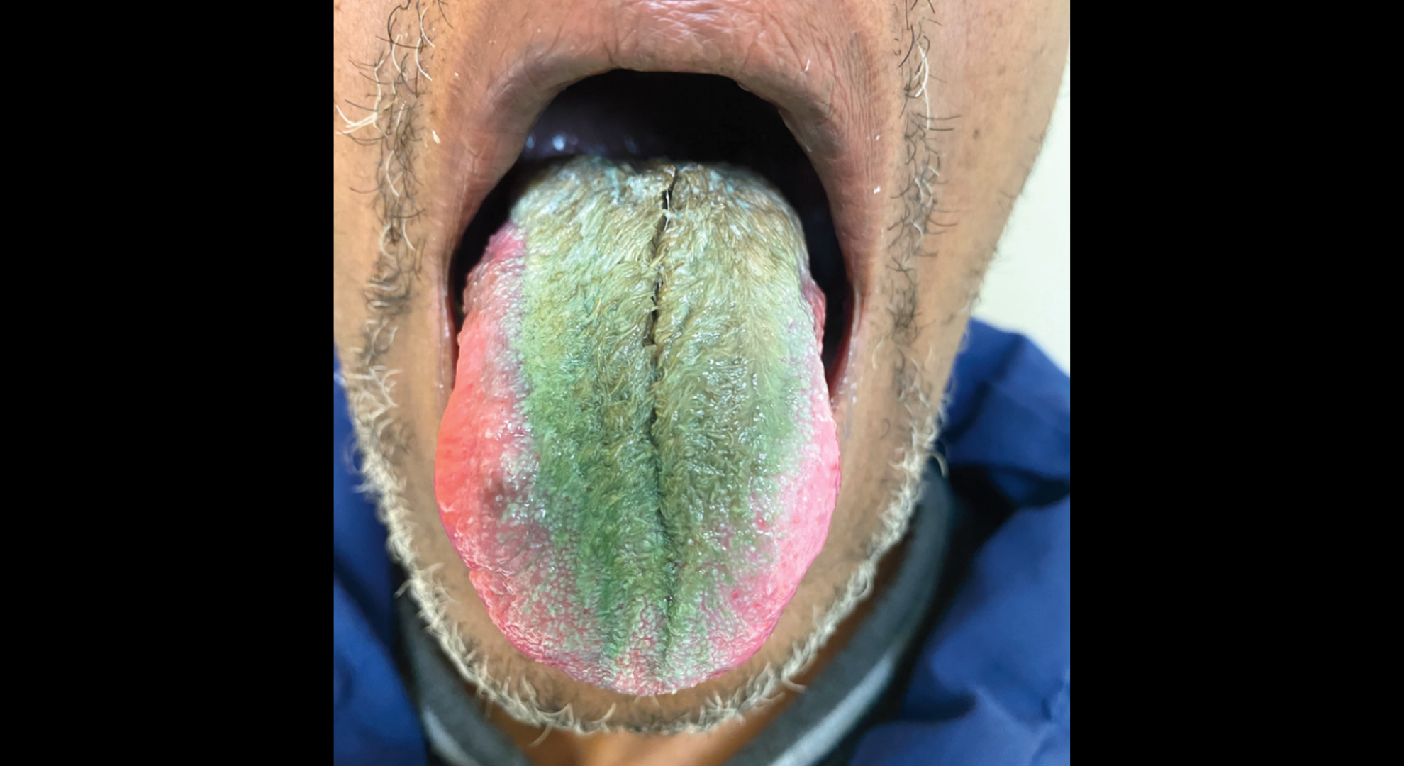 64歲老菸槍在服用抗生素後舌頭竟長滿綠毛