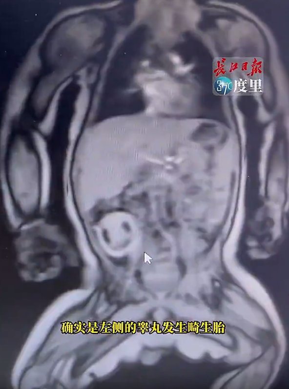 男嬰睪丸竟藏雙胞胎出生3月壞死醫急開刀分離