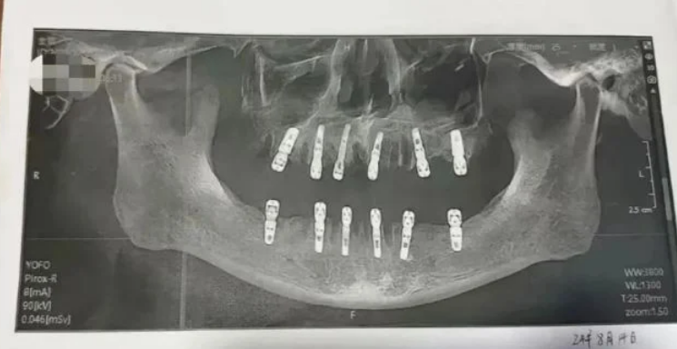 痛死！醫院下重手「一次拔光23顆牙」　中國男13天後心臟驟停亡