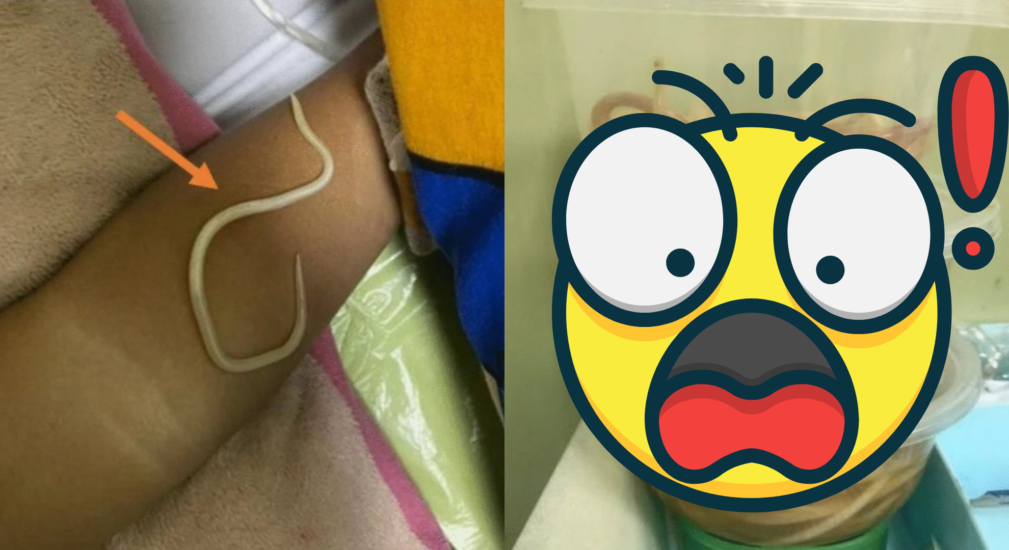 男童3天沒大便以為便秘！醫一照緊急開刀　震驚取出3罐蛔蟲