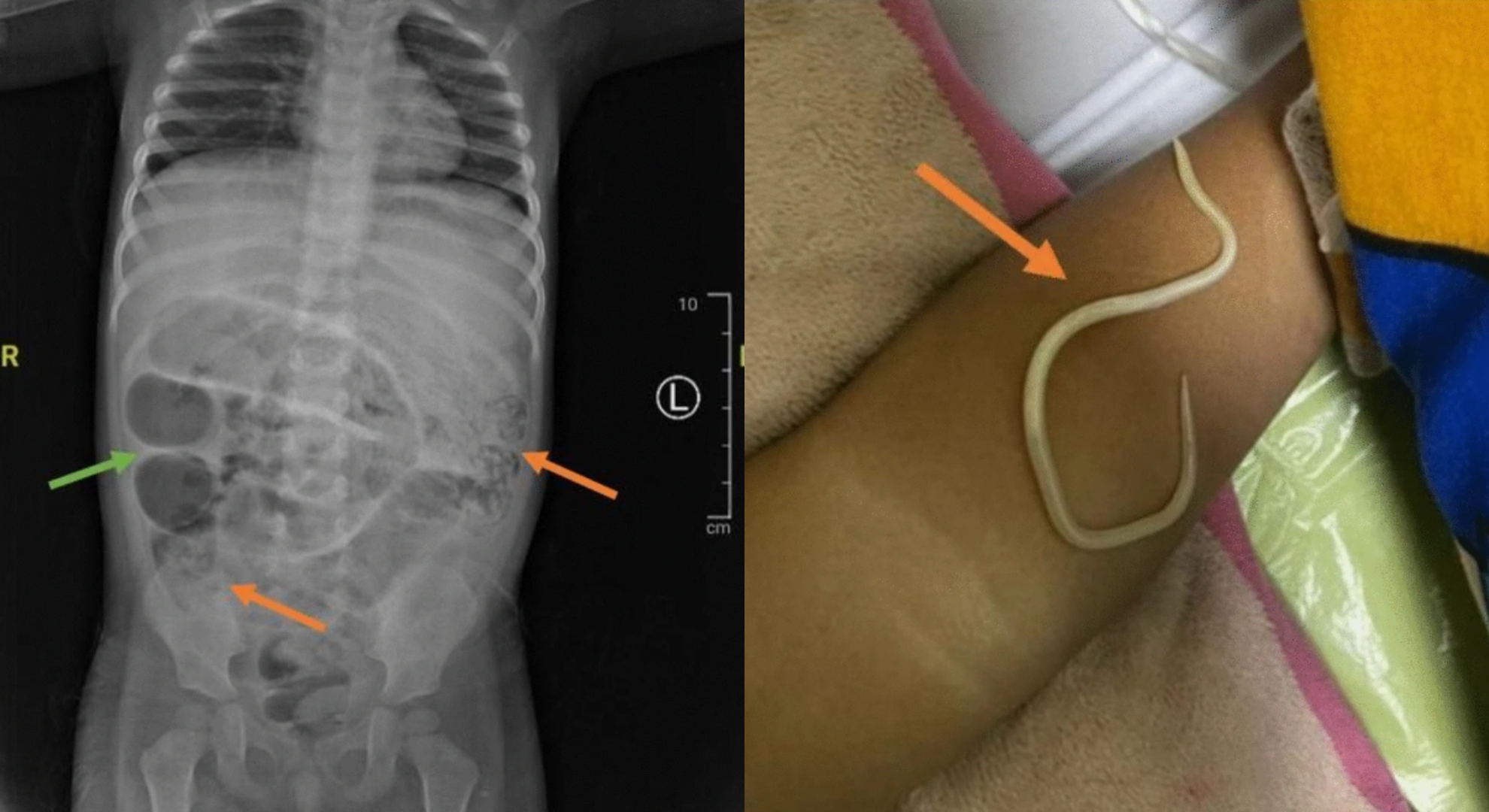 3歲男童便祕3天發燒就醫取出大量蛔蟲