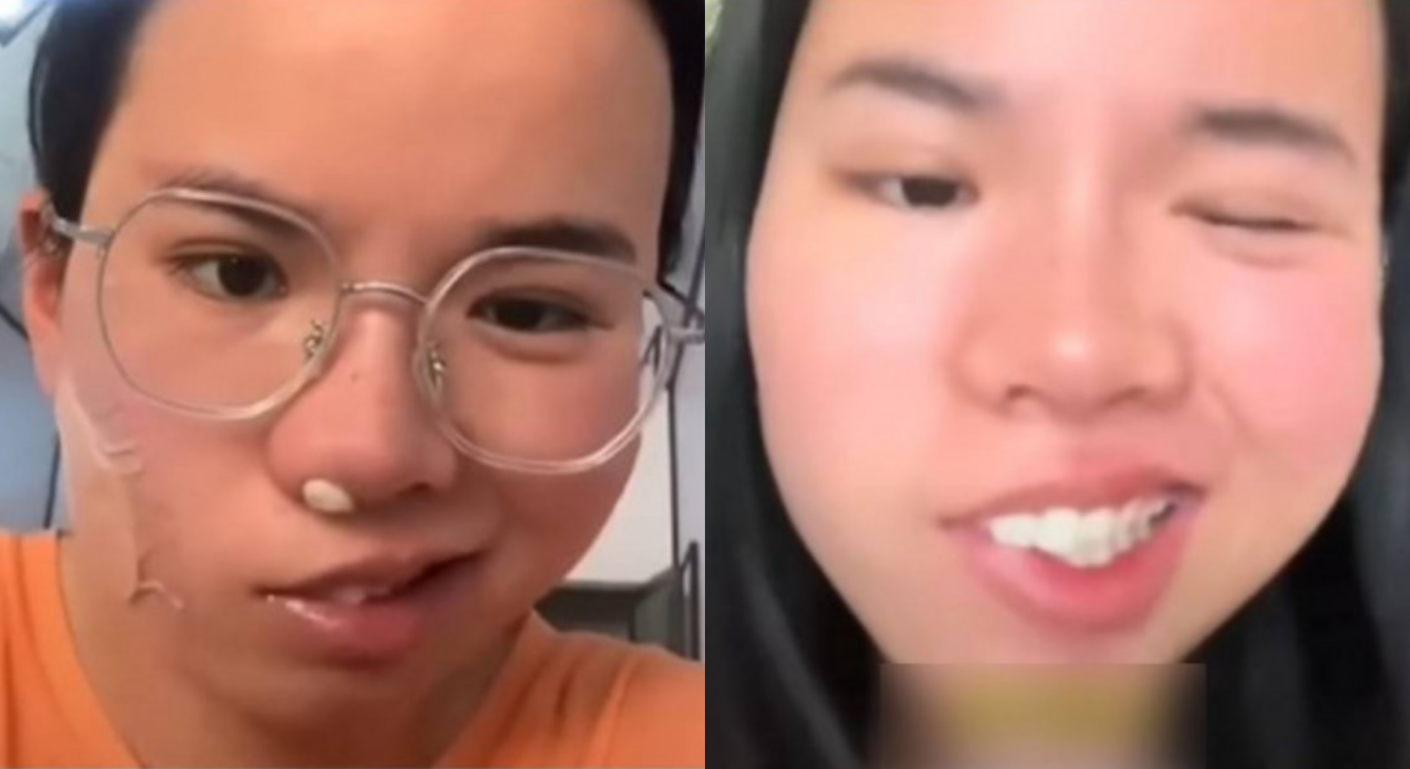 25歲女午覺睡醒「嘴歪眼斜」　醫示警：1類人發病機率高3倍