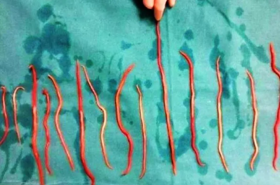 4歲女童鼻竄15cm活蛔蟲不治