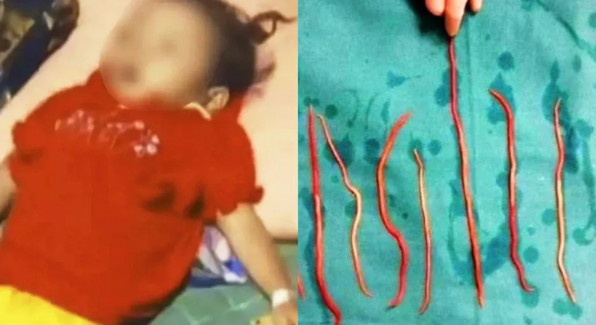 女童鼻孔鑽出15cm活蟲！送醫排出近1公斤寄生蟲　搶救9天宣告不治