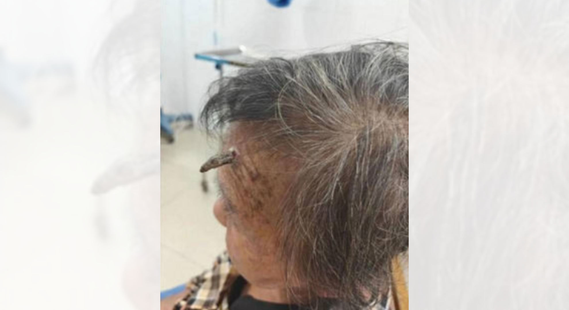 98歲婦額頭長出「龍角」！竟拿剪刀自行剪除　血流不止差點喪命