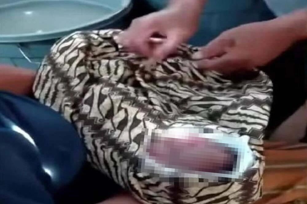 驚悚！印尼醫院接生「拔斷頭」滾地面　寶寶身體仍卡在母體內