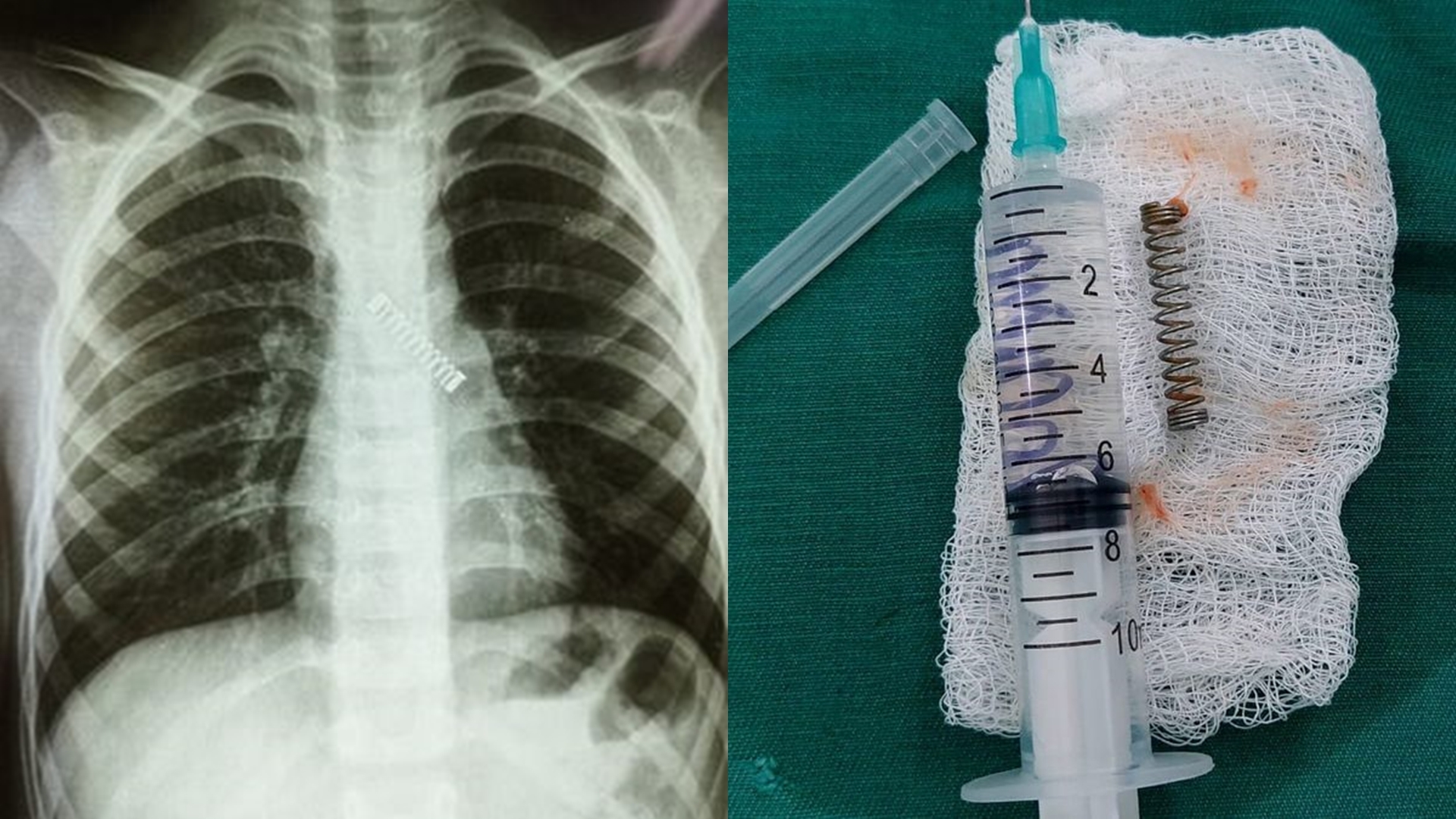 狂咳3個月！5歲男照X光「左肺竟卡彈簧」　醫緊急夾出：恐留1後遺症