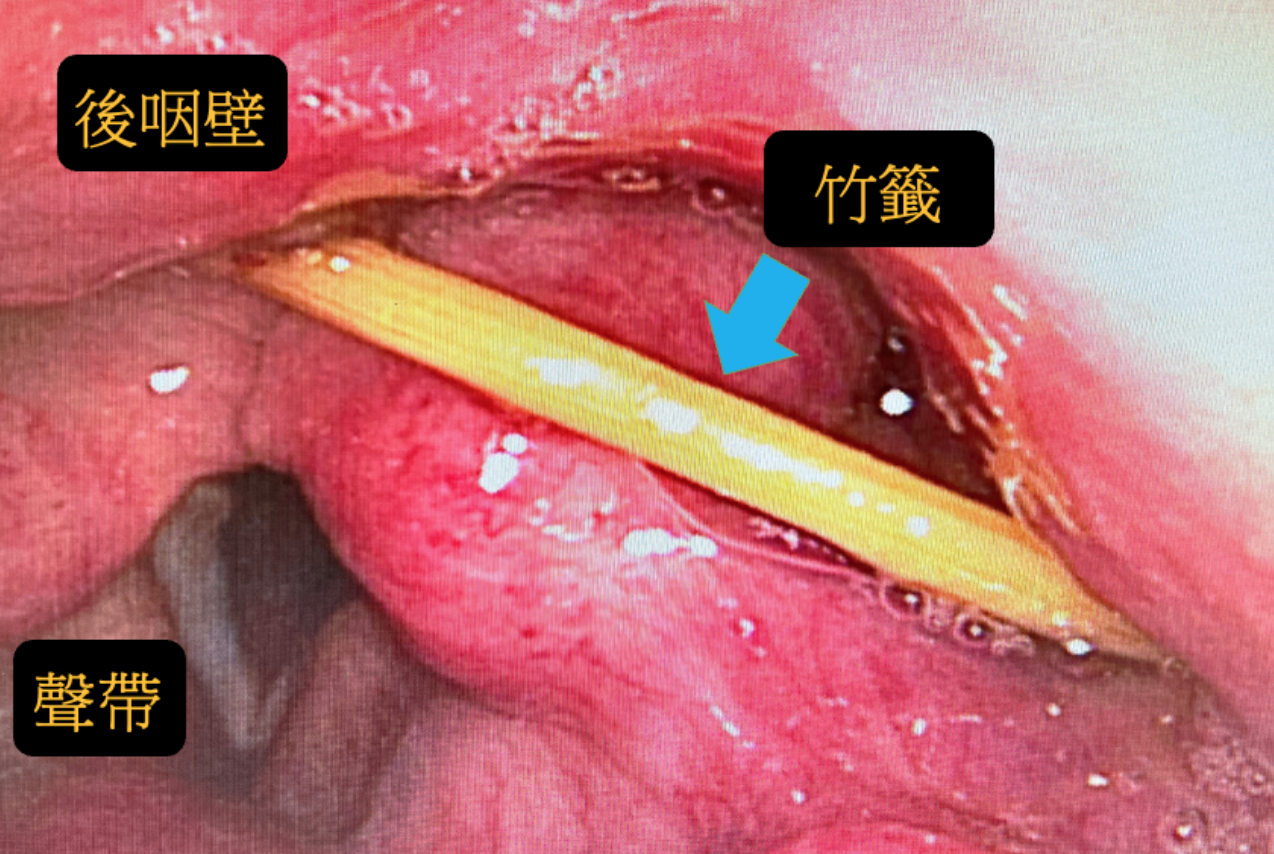 害怕不要看！男子吃烤肉太爽竟「連竹籤也吞了」　醫ＰＯ文嘆：真的難以置信！