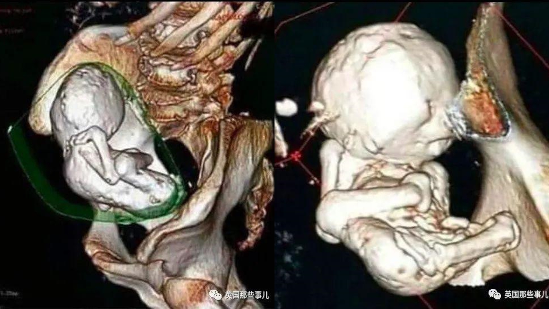 阿爾及利亞7旬老婦腹痛就醫　才發現懷胎35年鈣化成「石胎」