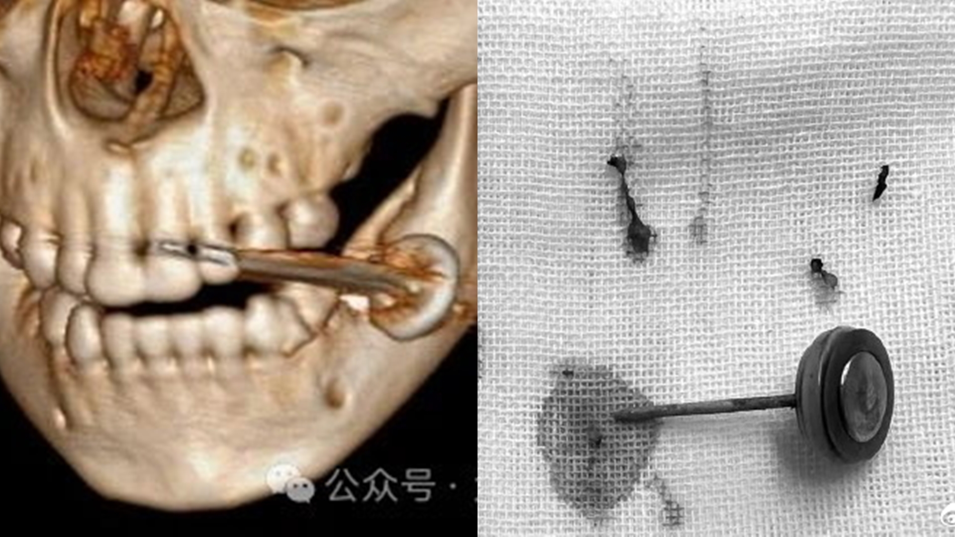 中國2歲童「好奇咬電池」釀爆炸！整張臉血肉模糊　送醫搶救撿回一命