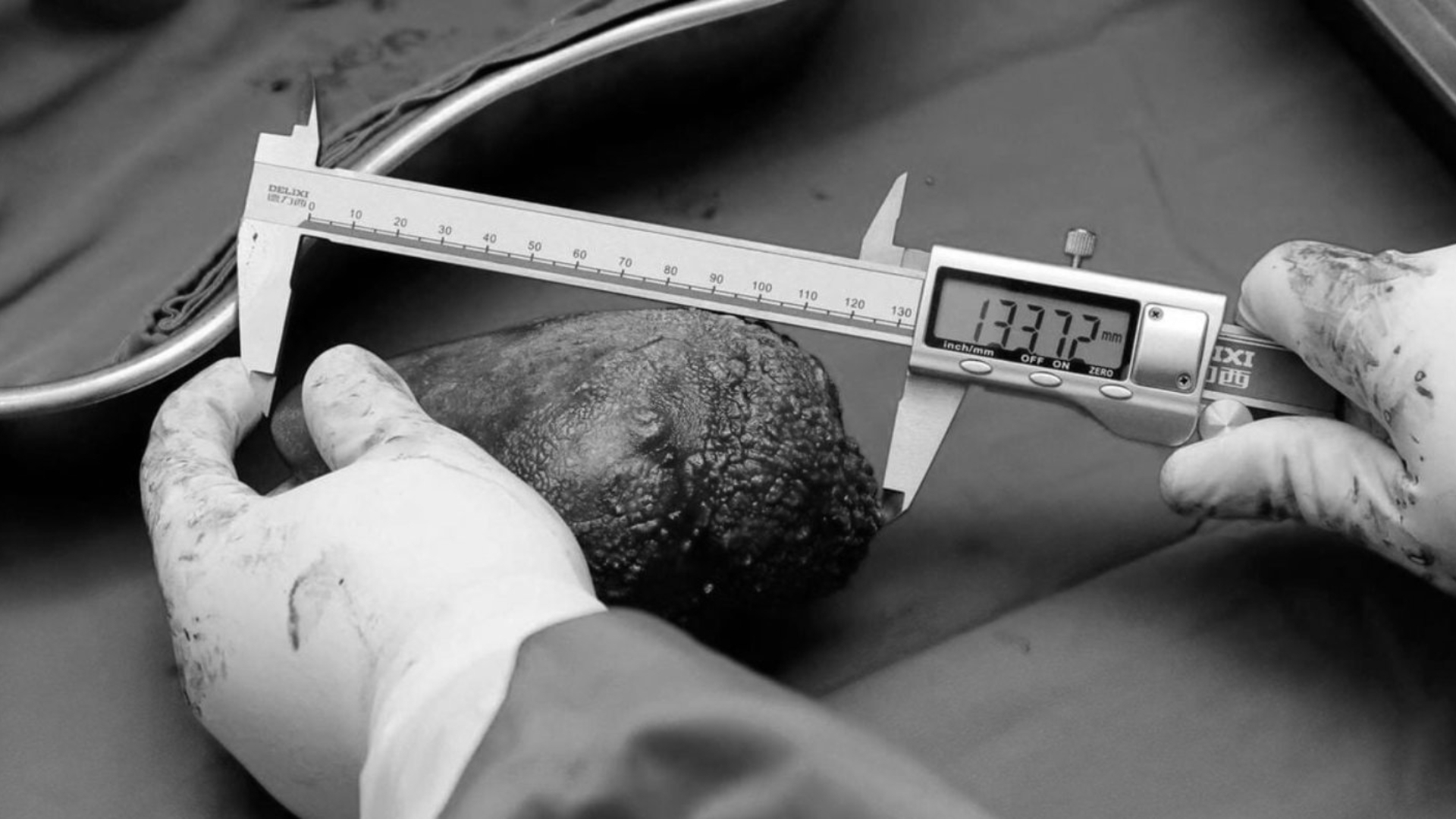 世界最大！斯里蘭卡老兵身上挖出「801克超巨腎結石」創世界紀錄