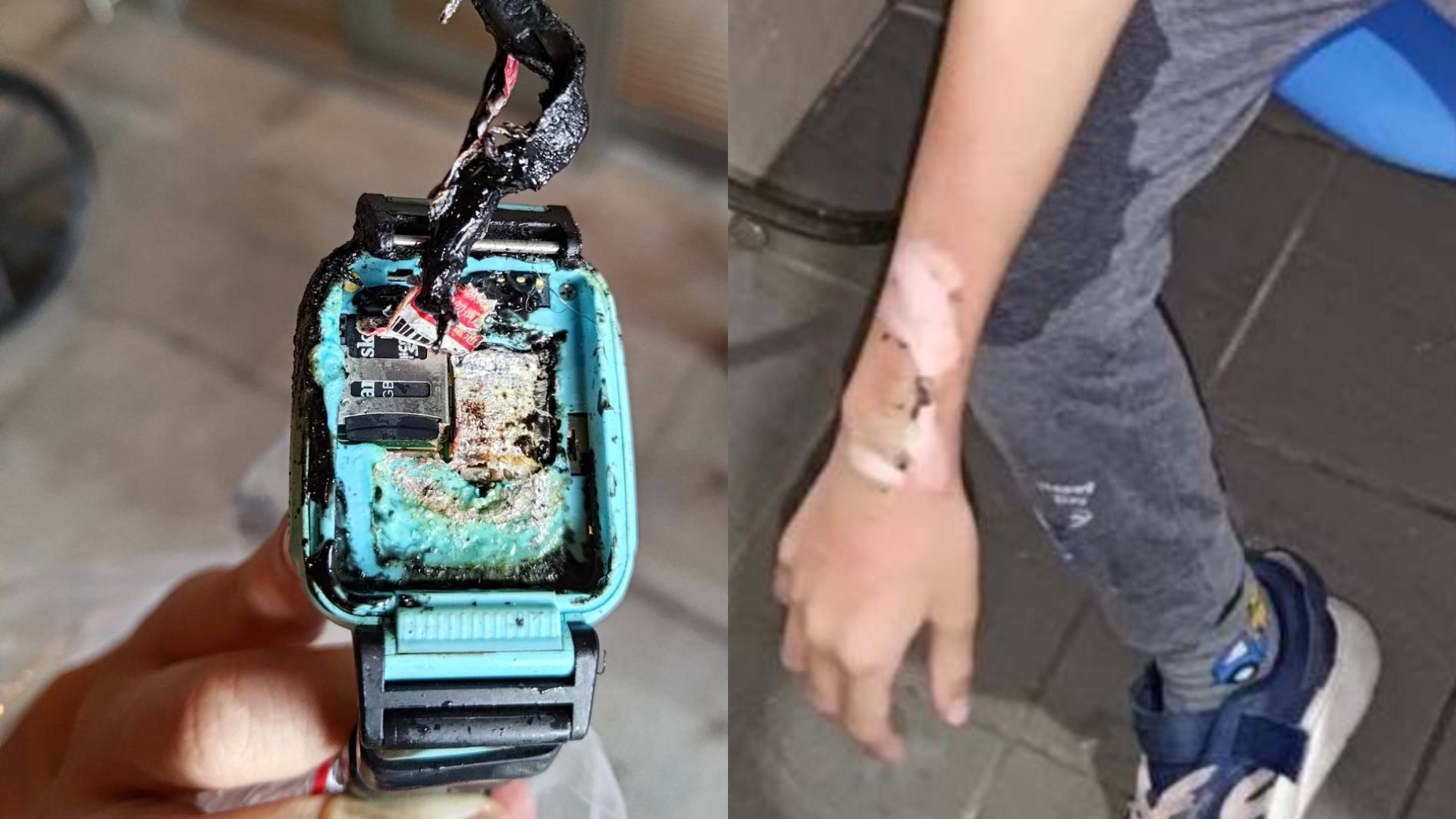 智慧型手錶突「爆炸自燃」！10歲童右手臂當場燒傷　送醫傷重恐需植皮