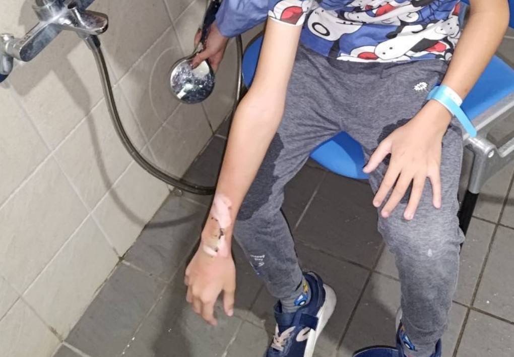 10歲童手錶突爆炸，傷勢嚴重