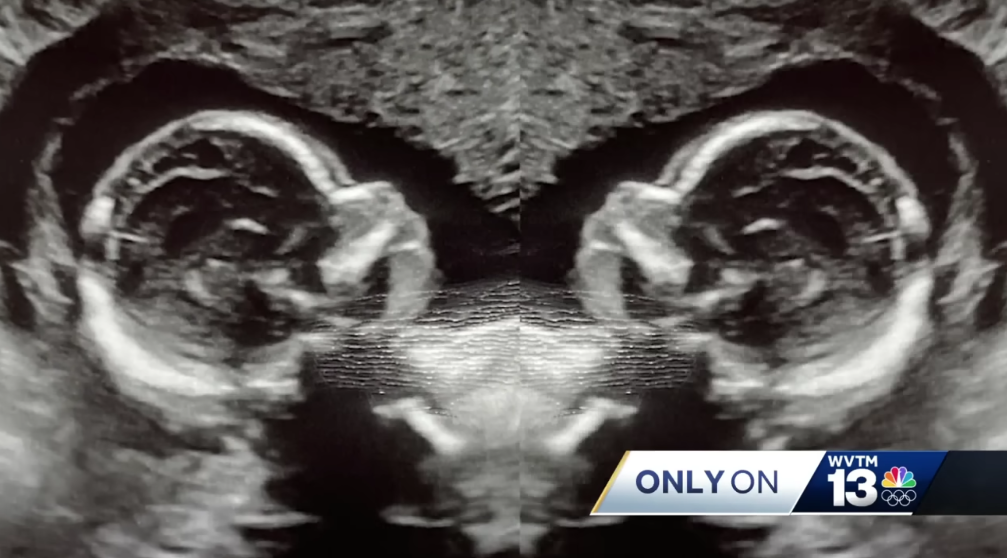 生命奇蹟！婦女擁有「雙子宮」同時懷孕2寶寶　醫師驚訝：這樣算雙胞胎嗎？