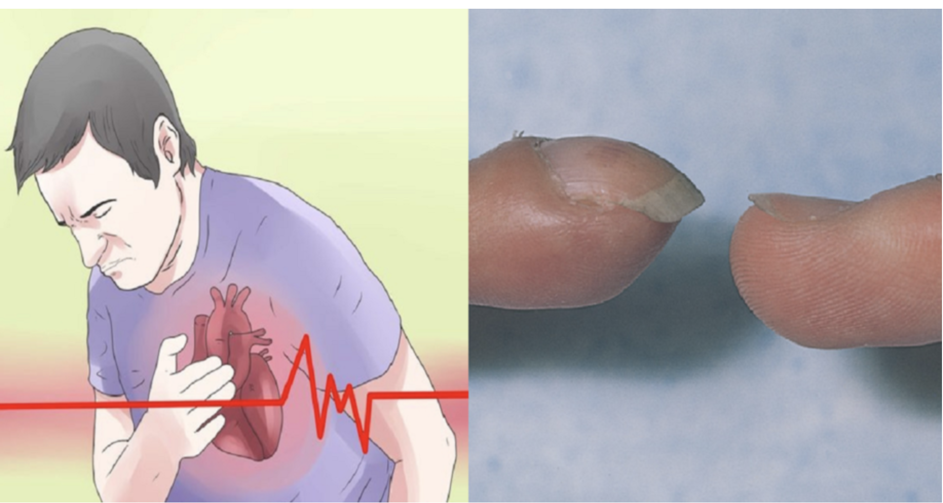 「心臟」好不好，看指甲就知道！指甲「7大警訊」，注意是心臟病、肝硬化和肺腺癌找上門了。