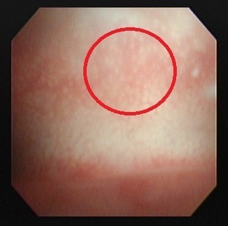 29歲女備孕7年未孕!醫揪3病症助「孕」到 竟懷上3胞胎省人工生殖費