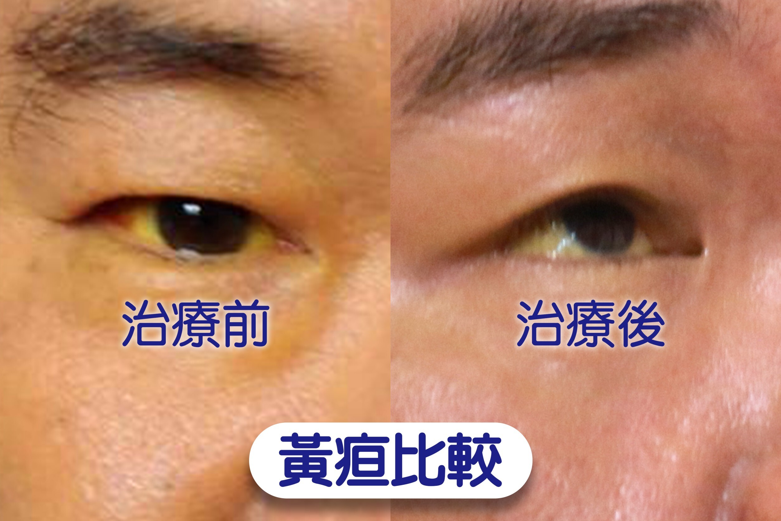 林先生治療接近兩周，黃疸症狀逐漸消退，但眼白依然看得到黃色。（圖／每日健康）
