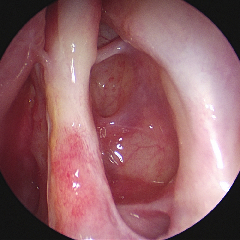 鼻竇發炎影響睡眠!醫揭「2大併發症」恐嚴重失明、腦部感染 早期別當小感冒