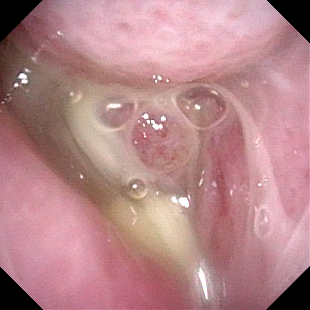 鼻竇發炎影響睡眠!醫揭「2大併發症」恐嚴重失明、腦部感染 早期別當小感冒