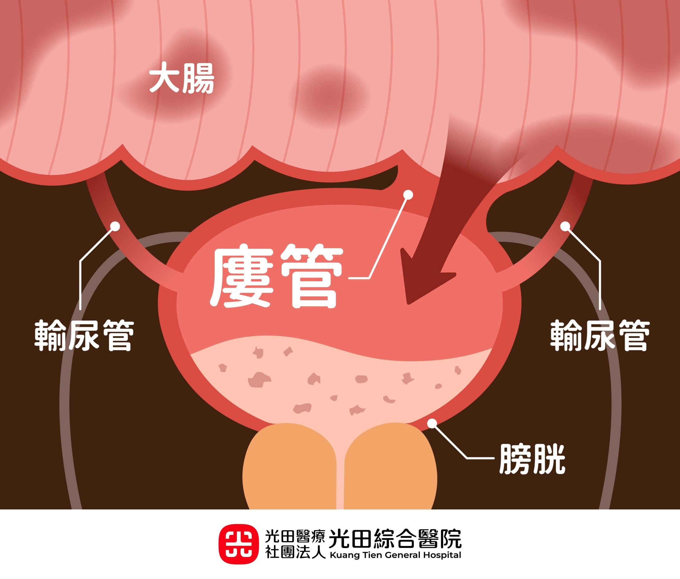 &nbsp;腸憩室發炎腸段與膀胱間已形成「大腸膀胱廔管」，導致老翁泌尿道感染。（圖／光田醫院提供）