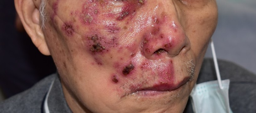 帶狀皰疹發作!痛到「吃不下、睡不好」小心嚴重併發症 皮膚科醫師:每3人就有1人會得