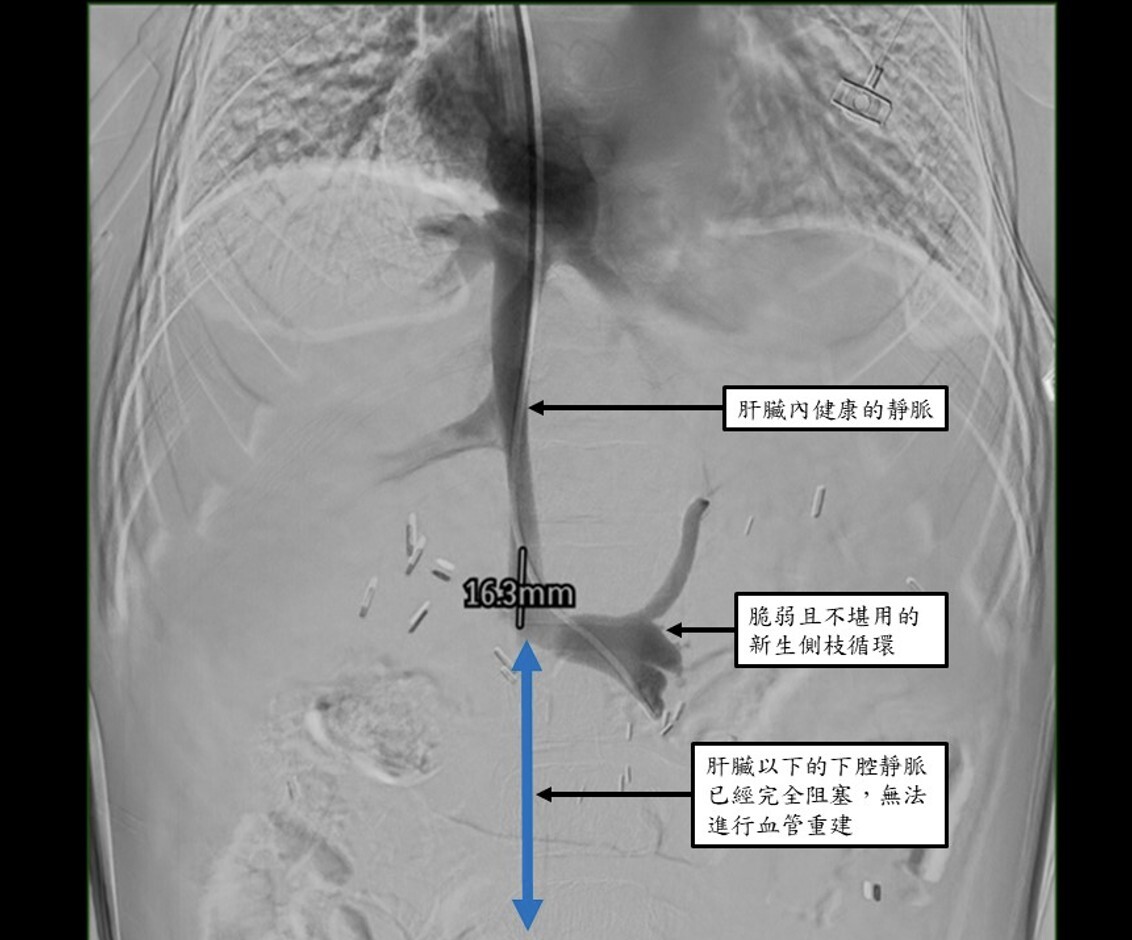 亞洲首例！台北榮總超強　成人腎臟「分肝種腎」：8歲女童脫離洗腎重生