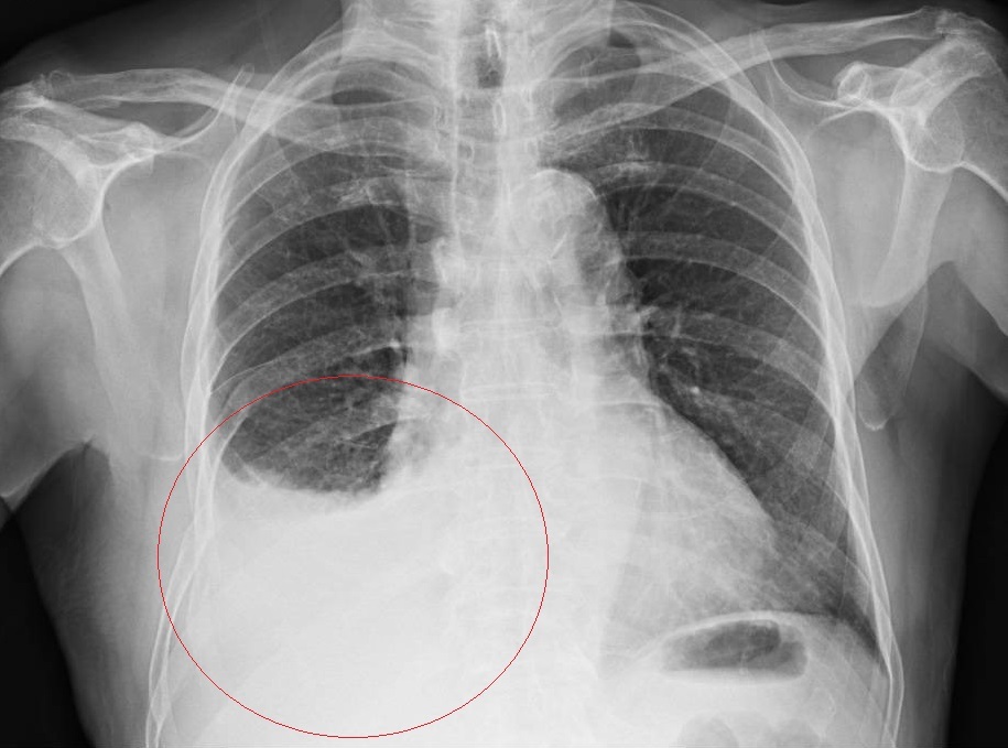 車禍撞斷9根肋骨!80歲老翁持續吃抗凝血劑反變「血胸」 差點休克