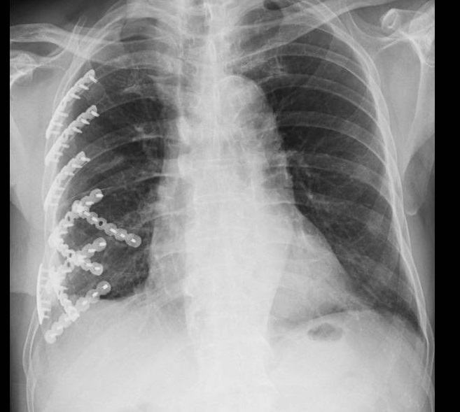 車禍撞斷9根肋骨!80歲老翁持續吃抗凝血劑反變「血胸」 差點休克