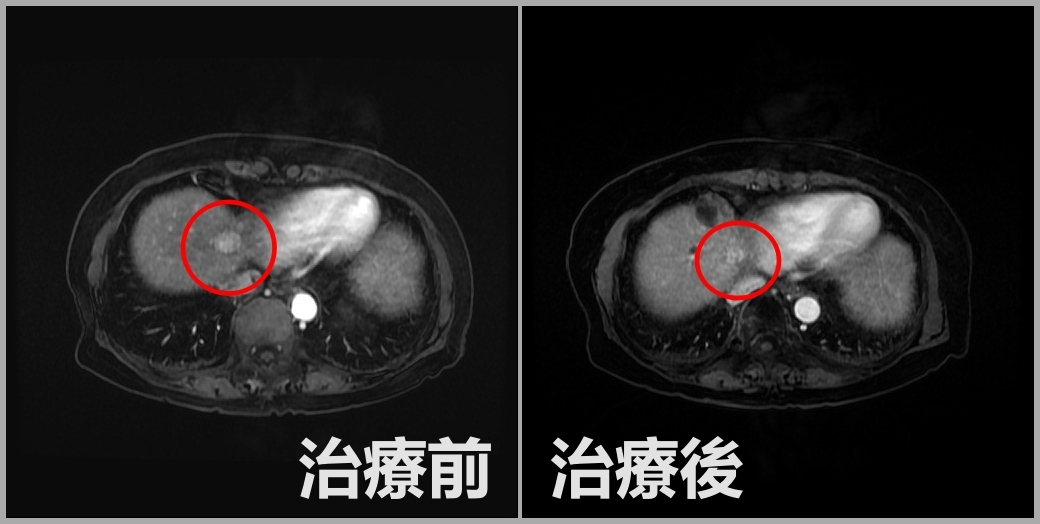  83歲廖奶奶抗癌成功：從肝硬化到清除肝臟腫瘤的勇敢旅程