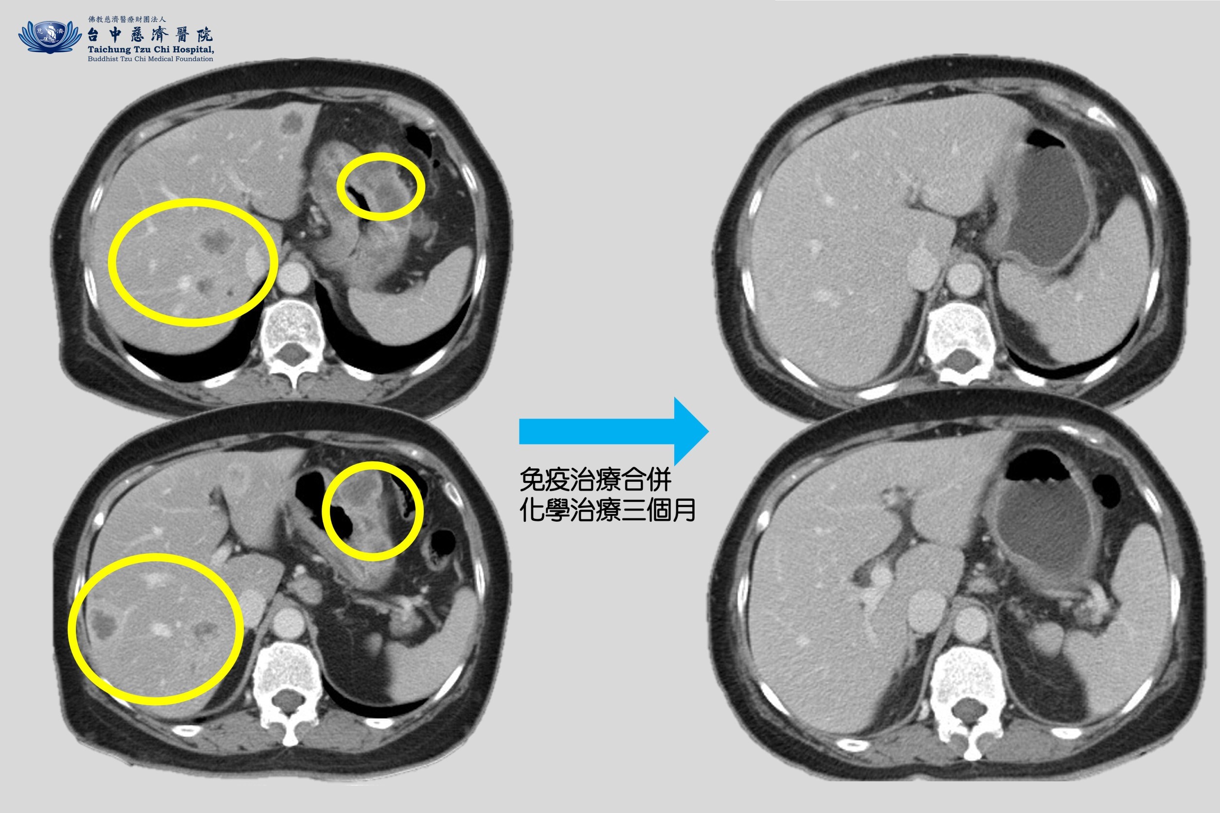  奇蹟抗癌：66歲徐女士胃癌四期轉移肝臟，免疫治療三個月完全緩解