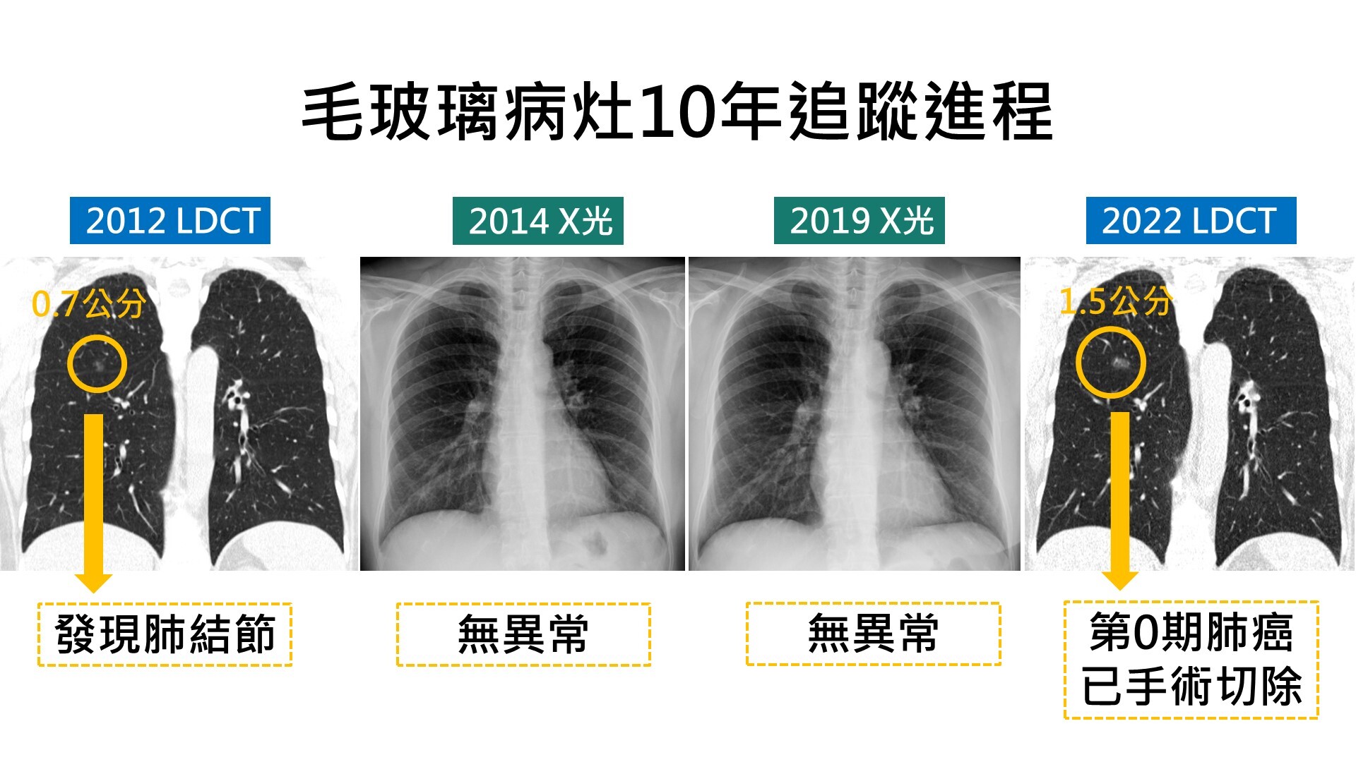 10年X光未發現!男子LDCT檢查揪出肺癌 早期發現預後良好